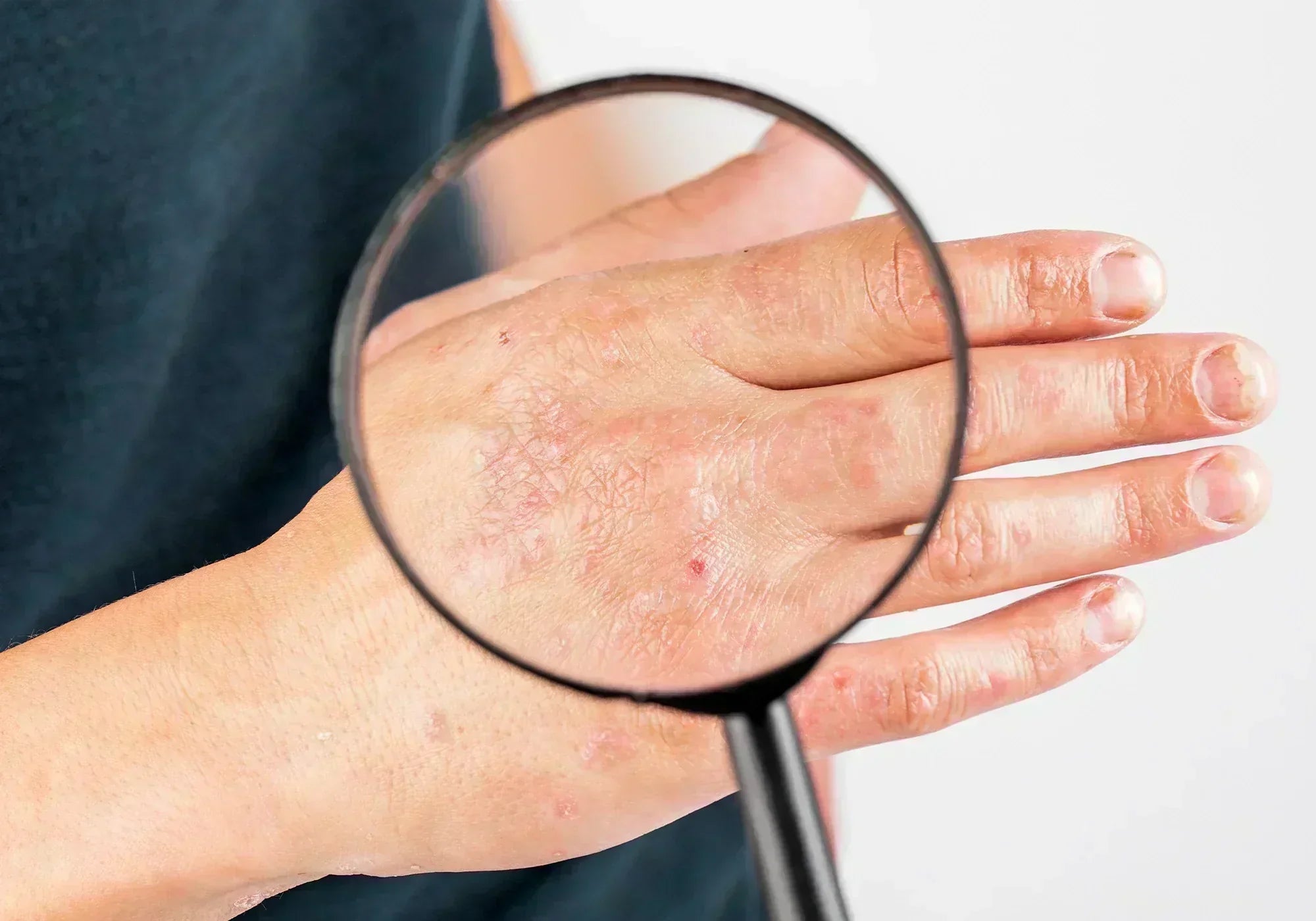 Лекува ли наистина котешката стъпка екзема?