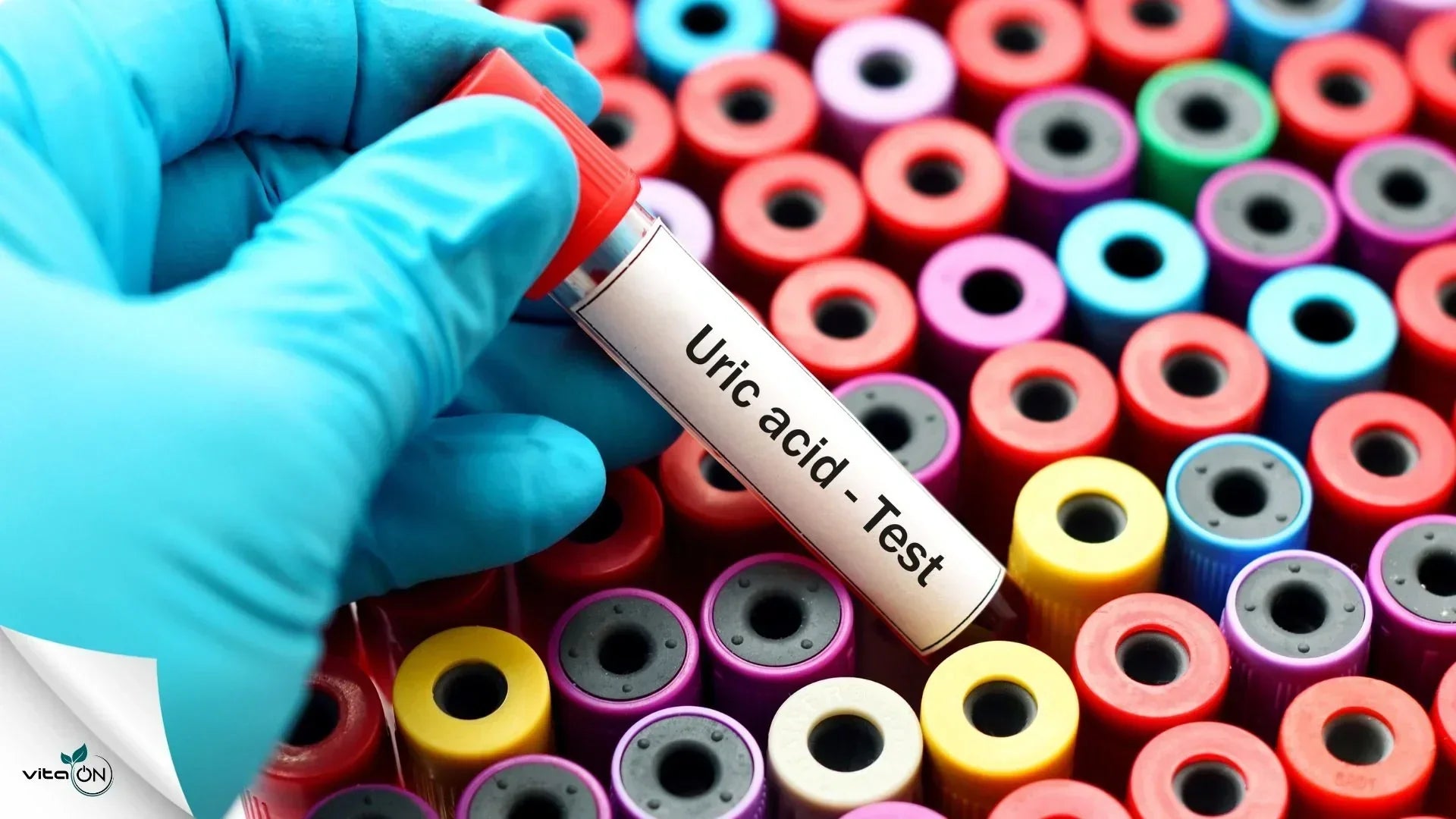 Пикочна киселина : симптоми при високи и ниски стойности