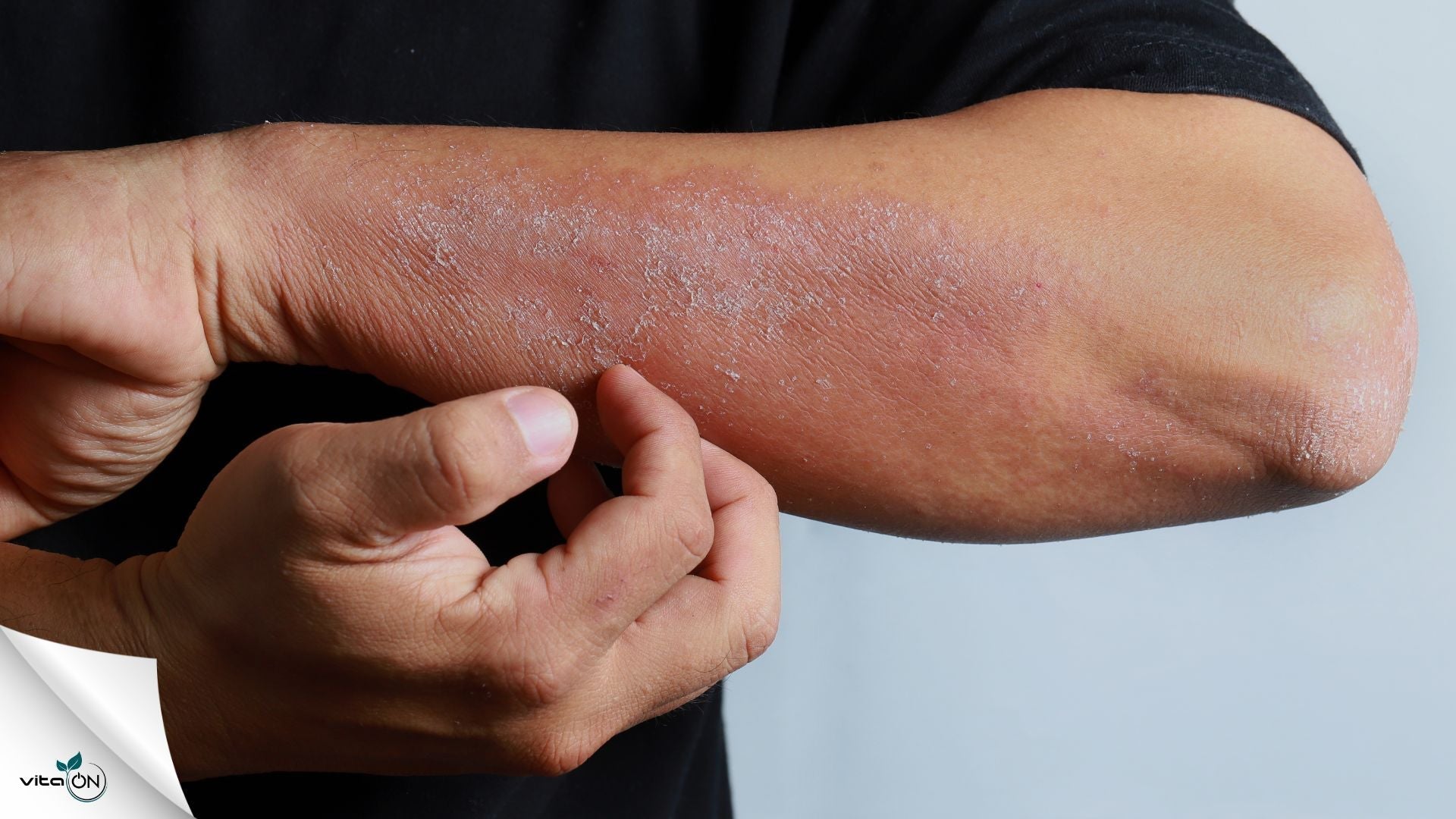 9 домашни лека за суха кожа